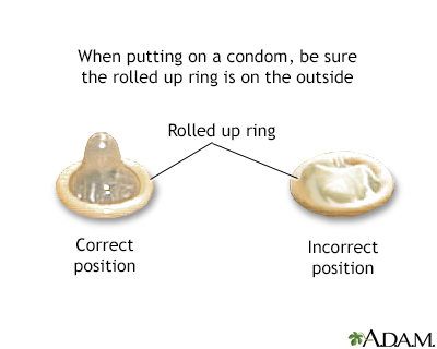 women condom image. Condom application - series