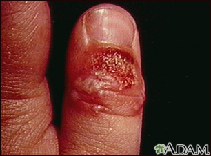 Herpetic whitlow is a viral finger infection that is caused by the herpes simplex virus (HSV). This infection is often extremely painful and like any other skin infection, highly contagious. Finger herpes or hand herpes gets easily transmitted by dir