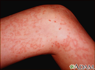 Wegeners Granulomatosis History | RM. Wegeners Granulomatosis History | RM.
